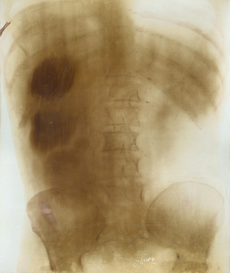 Prof. Contremoulin (attributed to) - Large X-Ray of a Torso